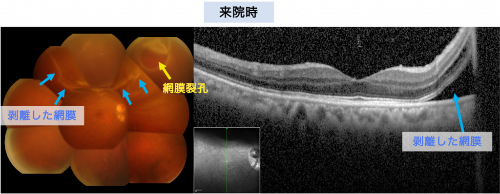 網膜剥離 | 新小岩眼科