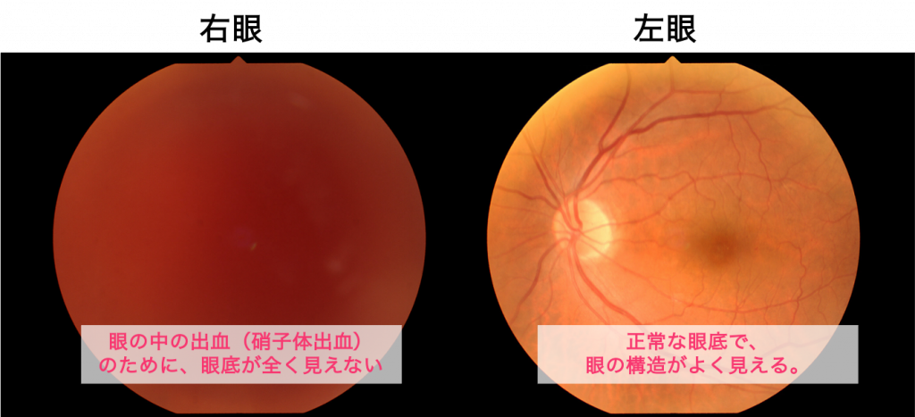 硝子体出血 | 新小岩眼科