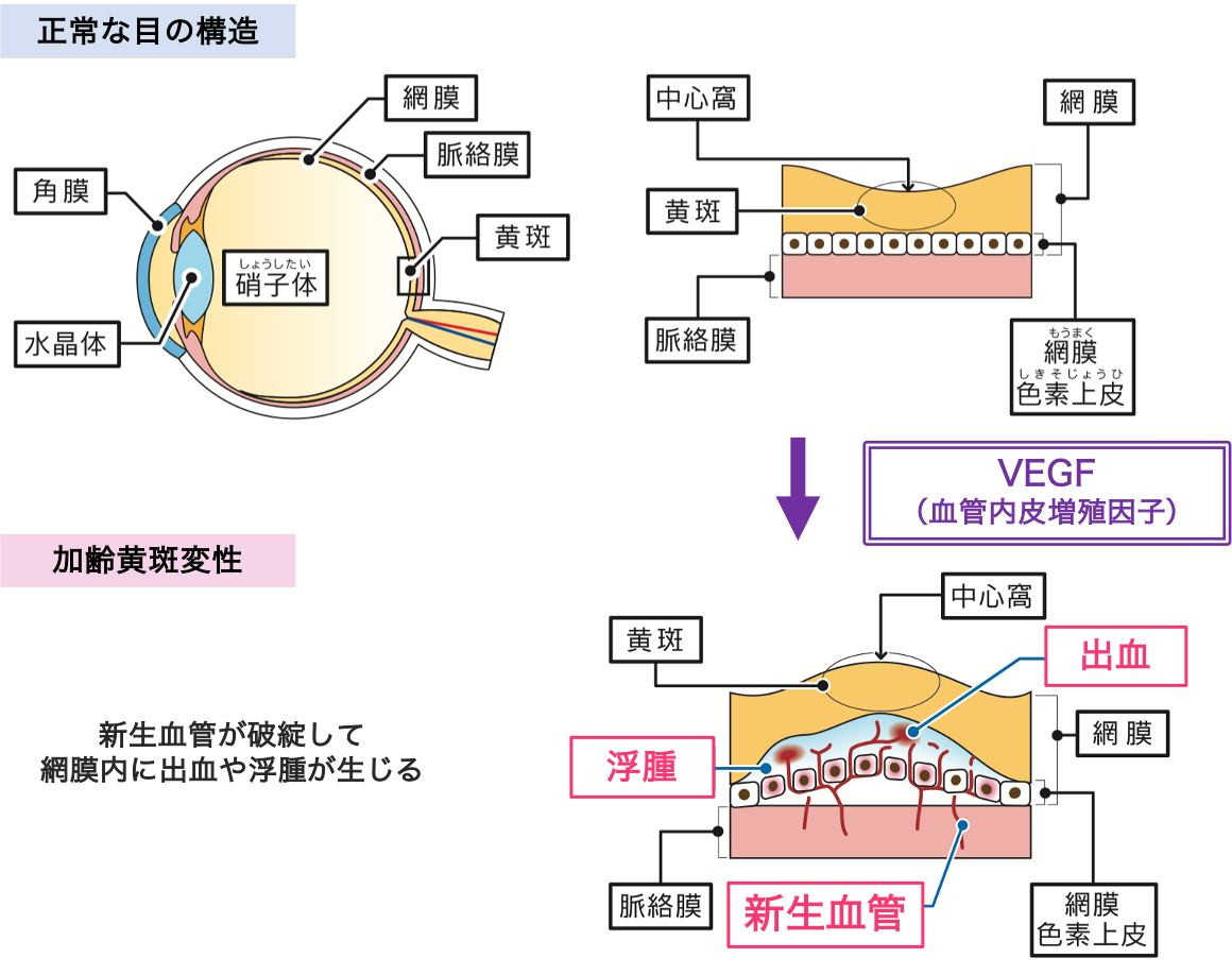 硝子体内注射 | 新小岩眼科