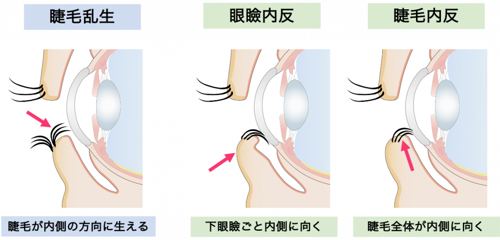 まつ毛 安い 奥に生える