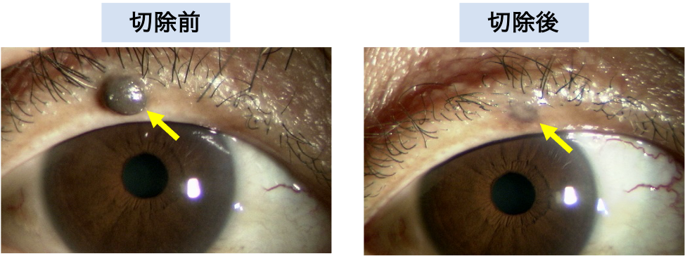 眼瞼腫瘍 | 新小岩眼科