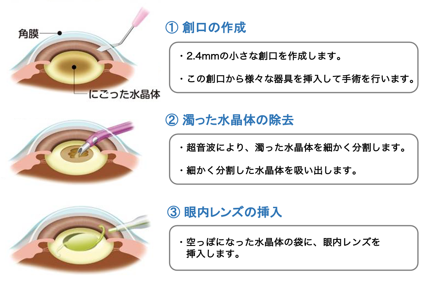 白内障手術の手順