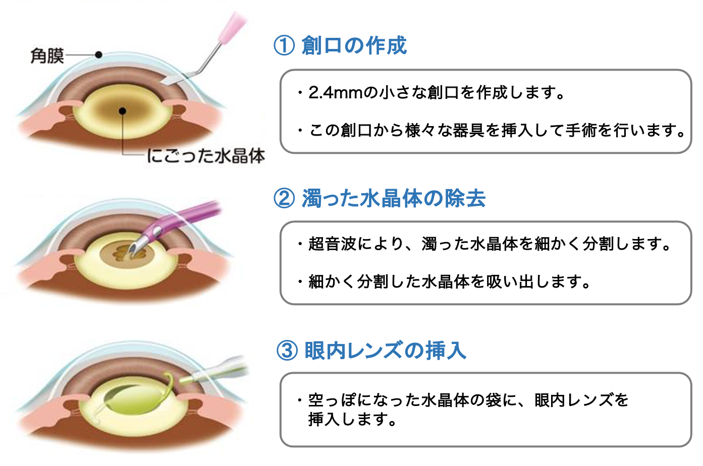 水晶体嚢外摘出術（ECCE）について | 新小岩眼科