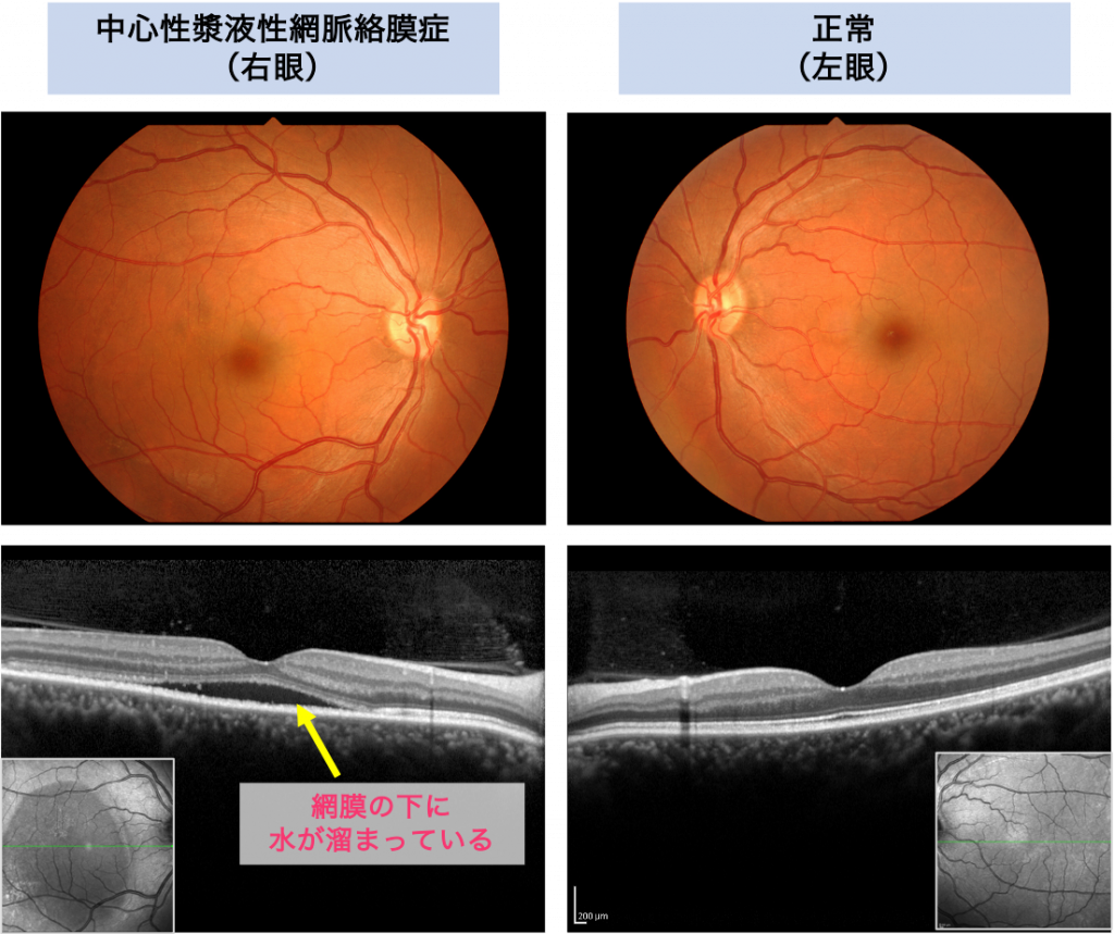 中心性漿液性網脈絡膜症（CSC） | 新小岩眼科