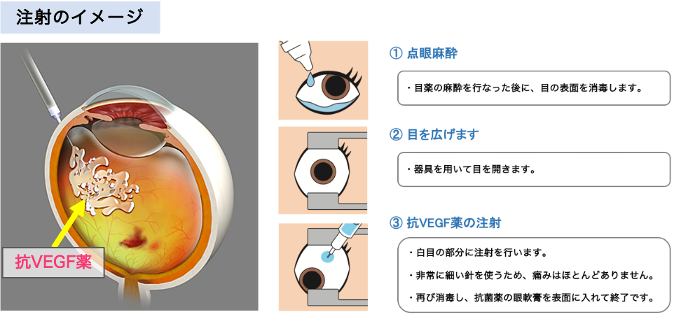 加齢黄斑変性 | 新小岩眼科