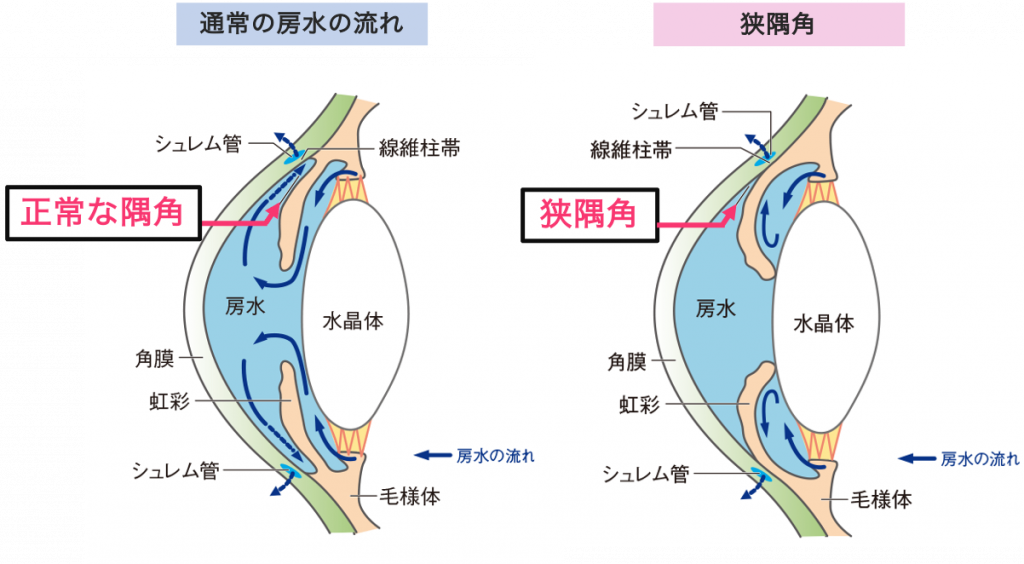 狭隅角、浅前房 | 新小岩眼科