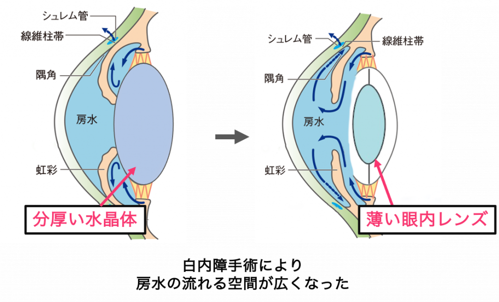 狭隅角、浅前房 | 新小岩眼科