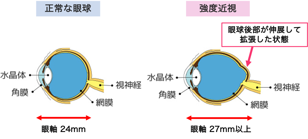 強度近視（病的近視） | 新小岩眼科