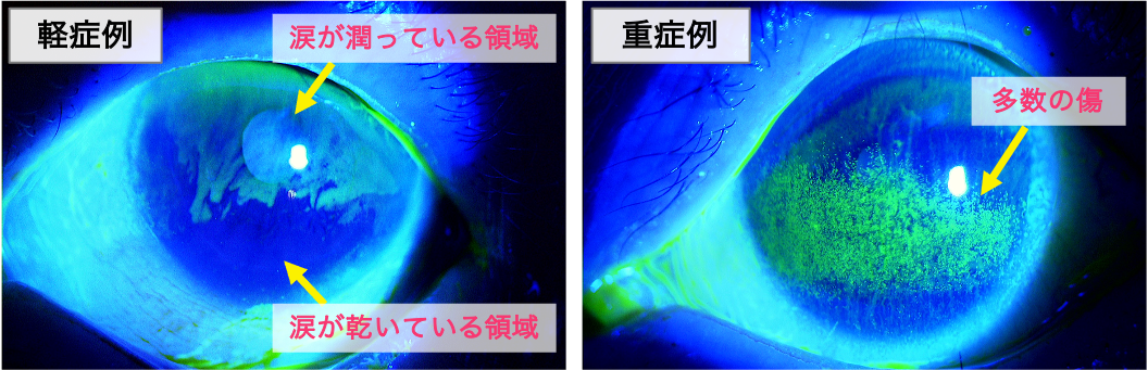 【裁断済み】眼科診療エクレール　ドライアイと涙道疾患ナビゲート 3 最新 ドライアイと涙道疾患ナビゲートー「涙」の問題はこの1冊