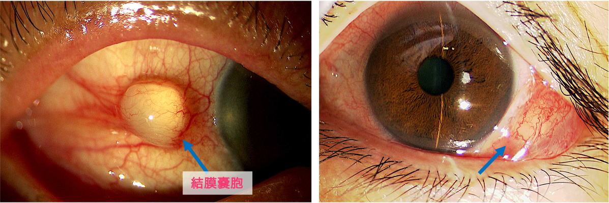 眼手術学　4 角膜・結膜・眼瞼手術 眼手術学 4 角膜・結膜・屈折矯正 - 眼科専門書店 オー・ビー
