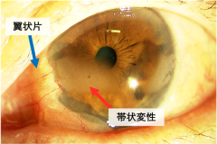 角膜ジストロフィ・角膜混濁 | 新小岩眼科