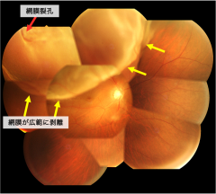 裂孔原性網膜剥離