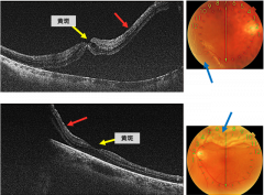 網膜剥離（黄斑剥離）