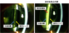 液状後発白内障