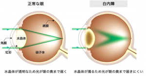 白内障とは