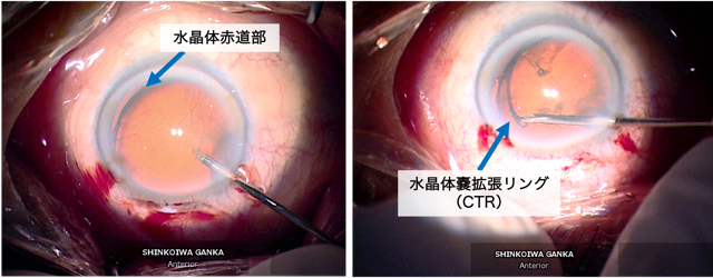 水晶体脱臼（水晶体嚢拡張リング使用）