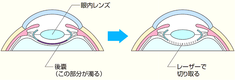 後発白内障　YAG後嚢切開術