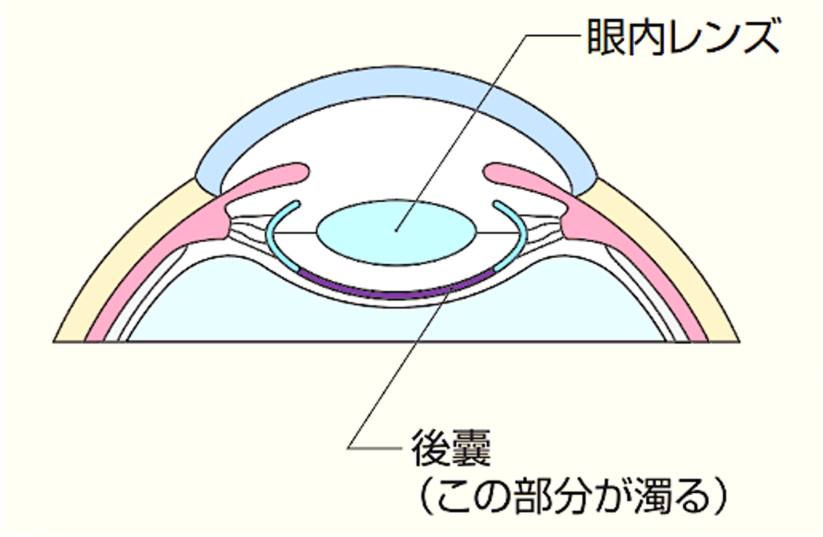 後発白内障