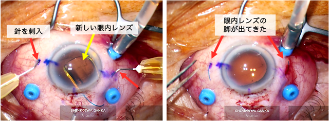 強膜内固定術（眼内レンズ挿入・固定）