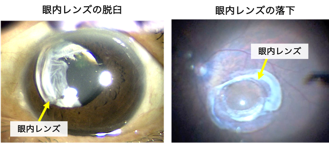 眼内レンズ脱臼・眼内レンズ落下