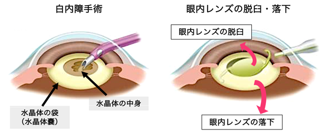 眼内レンズ脱臼・落下