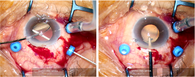 強膜内固定術（眼内レンズ摘出）