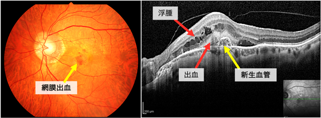 加齢黄斑変性（2型MNV）