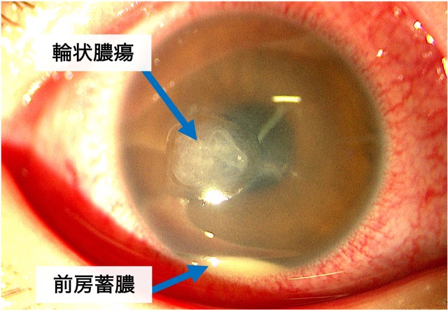 細菌性角膜炎（緑膿菌）