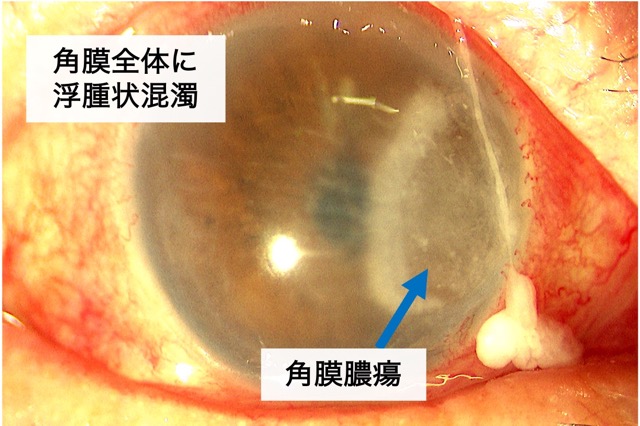 細菌性角膜炎（モラクセラ）