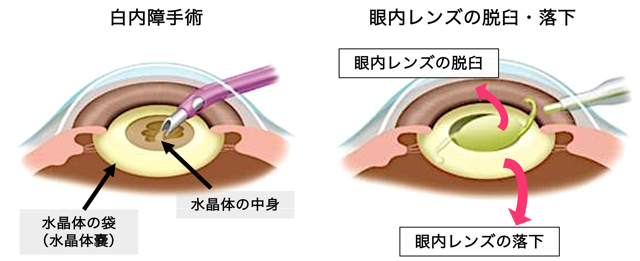 スタンダード白内障手術 メジカルビュー社｜眼科｜スタンダード白内障手術［Web動画付］