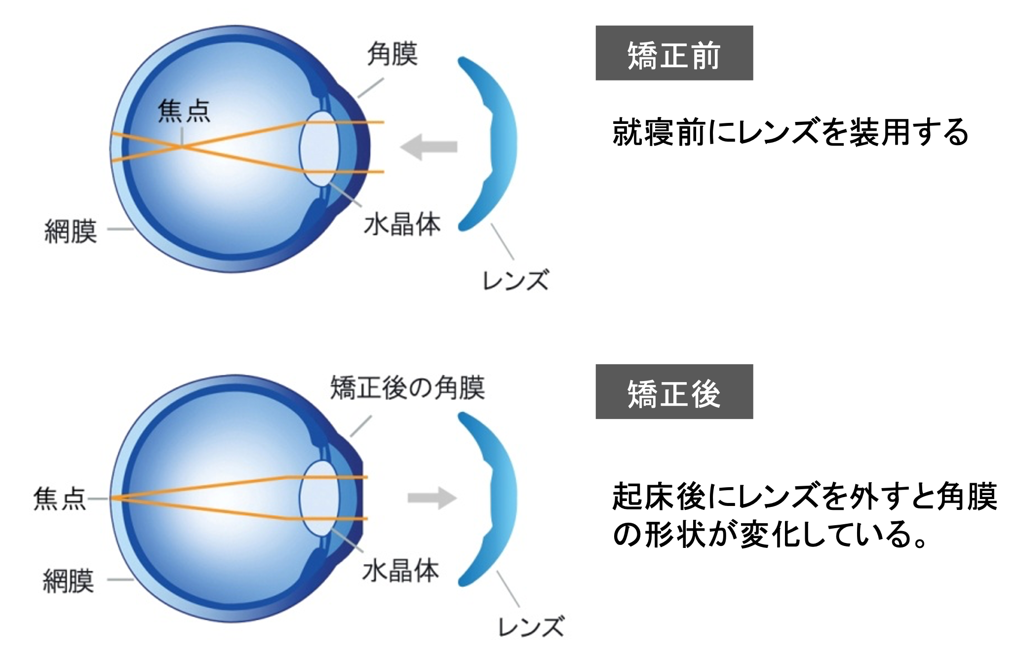 オルソケラトロジーの仕組み
