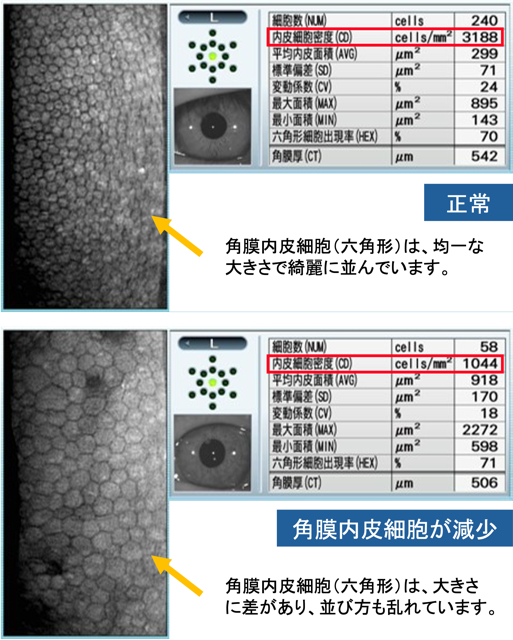 角膜内皮細胞検査
